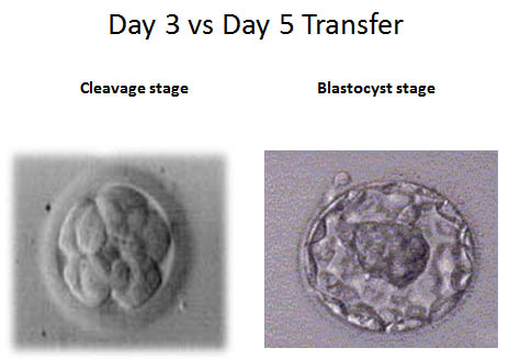 Comparison of Day 3 vs Day 5 fertilization